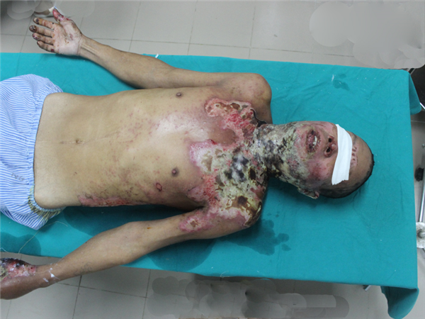 Cảnh báo khi tự ý điều trị bỏng tại các cơ sở y tế không được phép